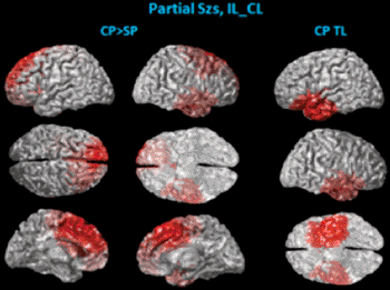 Image: Brain scans of test patients show that the frontal lobe of the brain is most involved in severe seizures (Image courtesy of University of Minnesota).